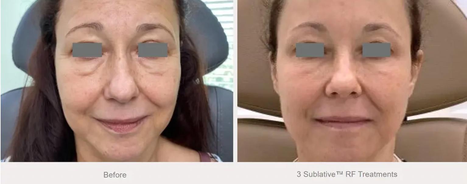 Reveal Better Skin: The Benefits of Candela Sublative Skin Resurfacing